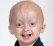 Progeria Research Foundation Progeria Research Foundation